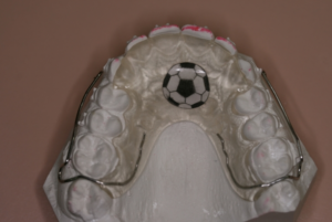 U Biteshelf with braces